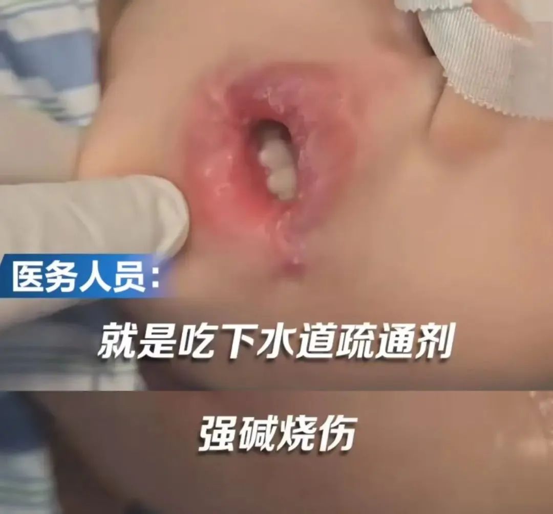 误食疏通剂紧急处理方法_管道疏通剂使用不当灼伤_管道疏通剂用法