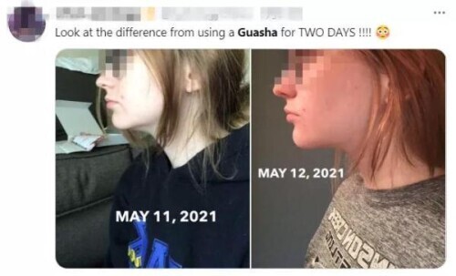 guasha benefits_刮痧美容效果_刮痧方法教程