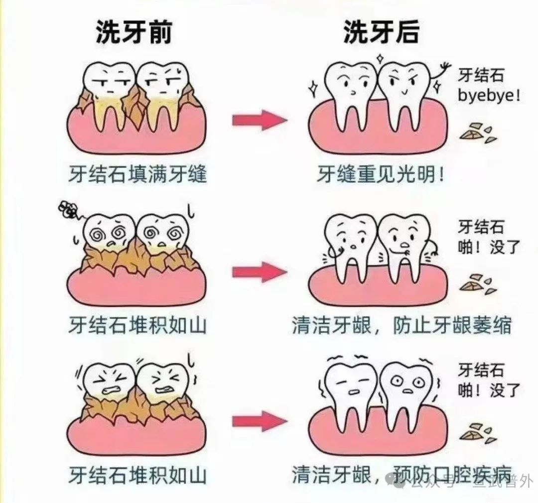 牙龈炎牙结石牙周炎口腔溃疡龋齿预防口腔卫生刷牙漱口巴氏刷牙法牙线使用漱口水定期洁牙洗牙口腔检查饮食习惯_口腔健康护理