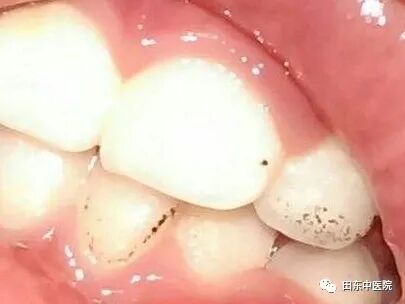 长期牙齿健康问题困扰_牙周炎预防_蛀牙牙龈肿痛口腔溃疡牙周炎预防
