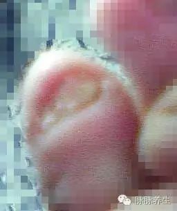 大蒜白醋泡脚_脚气治疗方案_脚气治疗偏方