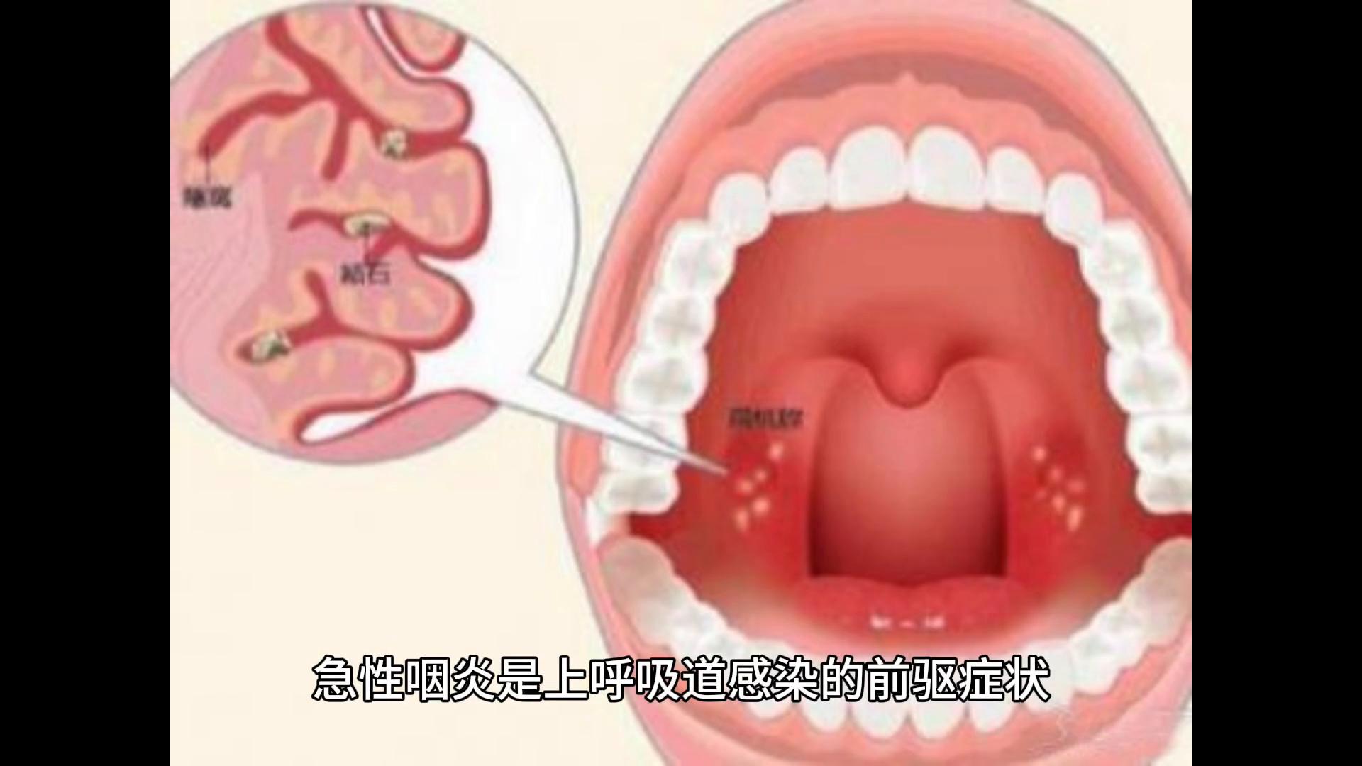 咽炎缓解技巧_咽炎症状_急性咽炎治疗