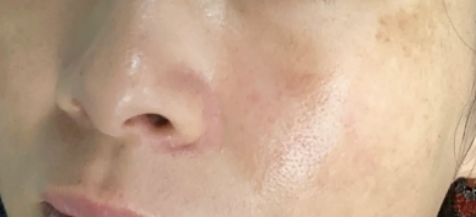 色斑淡化技巧_黄褐斑日常护肤维稳_强防晒保湿淡化黄褐斑