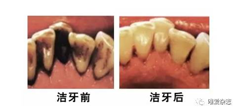 牙齿美白小妙招效果真实可靠吗_醋柠檬汁美白牙齿的危害_牙齿美白方法