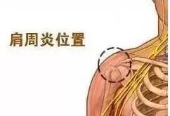 肩周炎锻炼_肩关节活动度训练_钟摆运动肩关节康复